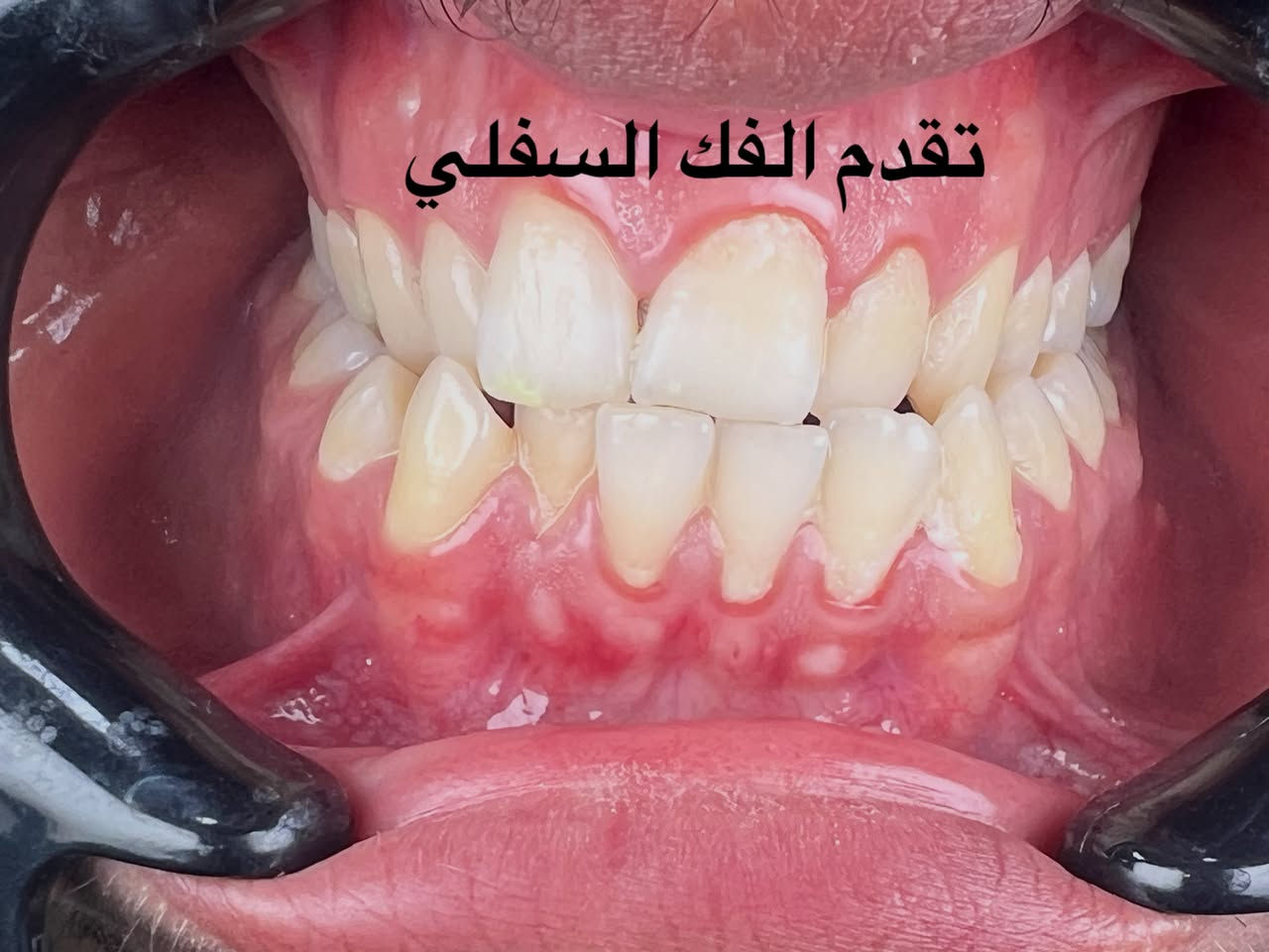 التقويم يميزنا احد حالات المعقدة و المستعصية ( الصور تتكلم عن الصعوبة) يعاني من مظهر خارجي غير متناسق غير مرغوب و انزعاجات حادة و صعوبة في تناول الطعام و اثناء الكلام بسبب الاسنان الطواحن الثلاثة في الفك العلوي مطمورة من الحالات النادرة جدا… علاج جميع الحالات الصعبة و المعقدة نتائج مضمونة خبرة طويلة في مجال الحالات المستعصية دقة في إتقان العمل ابتسامة مثالية اسعار مناسبة بالتقسيط المريح…. دكتور غزوان مزهر بغداد الكرخ نفق الشرطة بداية شارع الاطباء عيادة لوركا فوق صيدلية كنز النفق متوفر واتس *********** #تقويم_الاسنان #اطباء_تقويم_الاسنان #العضة_المعكوسة #العضة_المفتوحة #العضة_العميقة @تغليف_الاسنان_الزاركون @حشوات_الاسنان @زراعة_الاسنان @اطباء_تقويم_الاسنان @اطباء_الاسنان

نص مكتوب في الصور:
- ADAM CLINIC - ameer mouhmad التقويم يميزنا عن الصعبة و التحدي أتحدث الأسنان الطواحن الفك العلوي مطمورة
- تقدم الفك السفلي
- انعدم خط المنتصف
- طواحن الفك العلوي مطمورة
- ADAM CLINIC 2025-07-27 - ameer mouhmad طواحن الفك العلوي الثلاث مطمورة