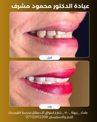 ابتسامة هوليوود • تجميل الأسنان • زيونة