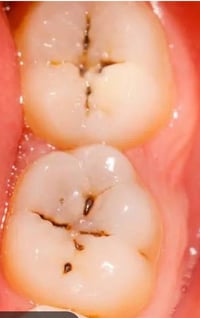 العلاج مجاني • تنظيف أسنان • جامعة اوروك كرادة