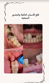 قلع أسنان • جذور متبقية • مجاني