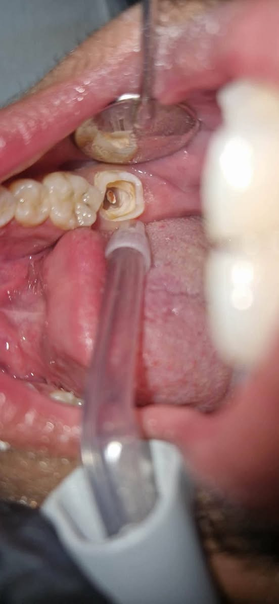 جزء من شغلنا بـ الحشوات التجميلية 🦷✨

مو بس حشوة… نرجّع شكل السن ونخليه يندمج ويا الابتسامة بشكل مرتب وطبيعي 😍

شغل نظيف وتفاصيل تفرق بالابتسامة 🤍

📍 بغداد – الأمين الثانية – شارع المهداوي
📞 *********** @highlight
