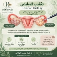 تثقيب المبايض • تكيس المبايض • د. هبة الهلالي