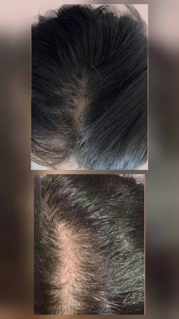 وداعاً للفراغات 👋
حالة انبات شعر بتقنية الاكزوسوم Exosome
الجلسة الرابعة والنتيجة مثل ما تشوفون، انبات جديد وفرق بالكثافة
بإشراف الدكتورة هيلين ابو الهيل 
مجمع علم الكندي الطبي التخصصي  - بسمايه شارع العام قرب ماركت زاد الخير 
✨ النتائج تختلف من شخص لشخص والالتزام بالجلسات هو السر

نص مكتوب في الصور:
- وداعاً للفراغات
- حالة انبات شعر بتقنية الاكزوسوم
- Before
- After
- مجمع علم الكندي الطبي التخصصي - بغداد
- النتائج تختلف من شخص لشخص والالتزام بالجلسات هو السر
- مجمع علم الكندي الطبي التخصصي
- 0770 XXX XXXX
- بغداد - العراق