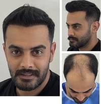 زراعة شعر • جلسة واحدة • المنصور