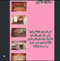 قلع أسنان • طقم جزئي • علاج مجاني