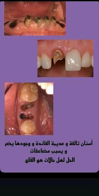 🦷🖤

يسرّني استقبالكم في عيادات الأسنان لتقديم خدمات طب وجراحة الفم والأسنان بأحدث التقنيات وبعناية متكاملة.

🔹 استقبل قلع الاسنان هكذا حالات كما موضح في الصور
🔹 حشوات مؤقتة ودائمية
🔹 طب أسنان الأطفال
بأشراف نخبة من الاطباء المختصين

👨‍⚕️ الدكتور علي عدنان رزيق 

📞 للحجز والاستفسار:*********** او مراسلة الصفحة 
📍 حلة – شارع 40، عيادات جامعة الحله مجاور صيدلية سلامتك
علما إن العلاج مجاني بلكامل