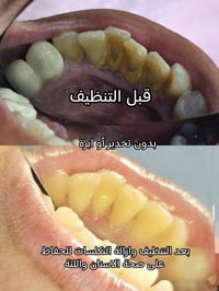مجاني • تنظيف الاسنان • شارع فلسطين