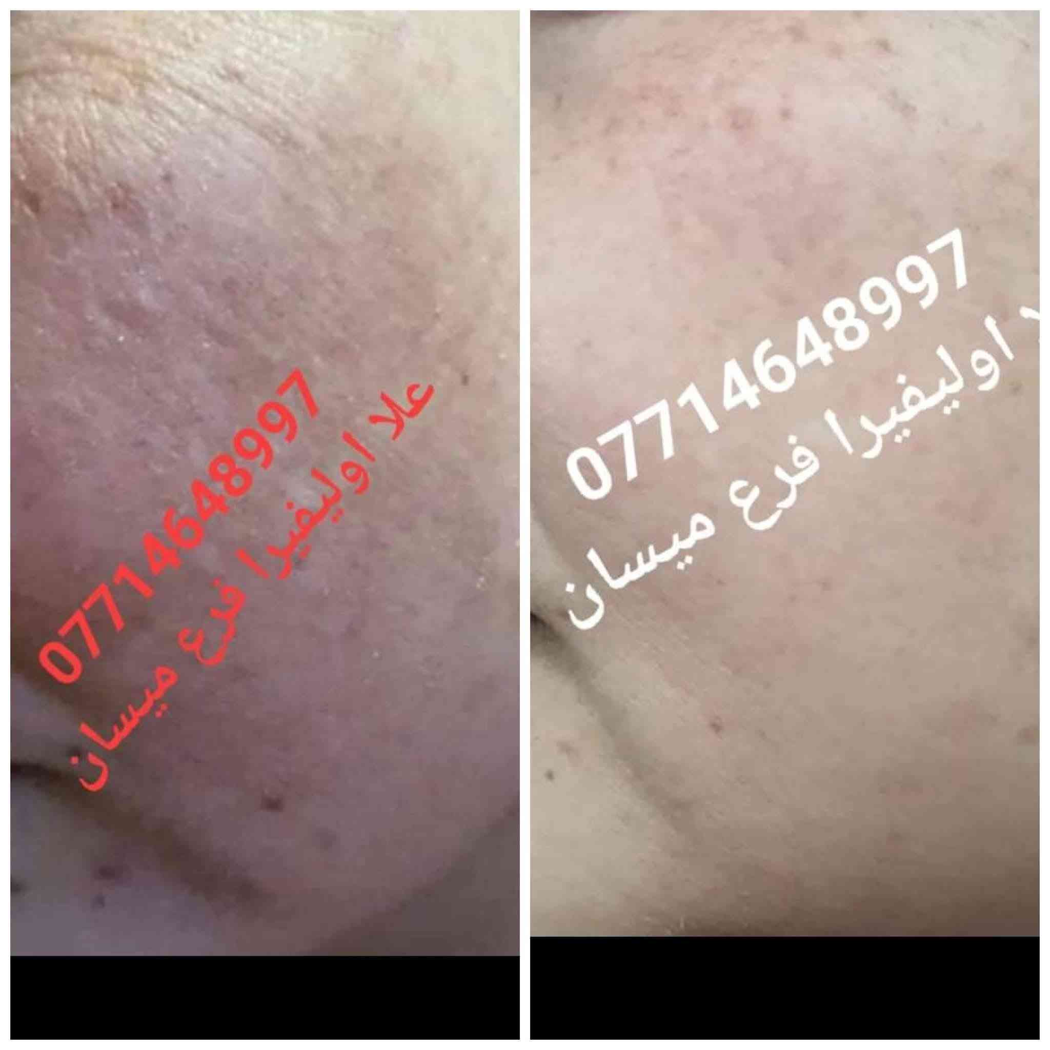 مع بكج العنبر المتكامل ماكو مستحيل 💪 منتجاتي الي اثبتت جدارته 🫶🏻ربي لك الحمد 🤲
عنوانه الثقه وتجاربنا تشهد  🫶 
انتبهو على تجارب كولهن بالارقام الهاتف  افتحو الصوره 
احبكم واحب تجاربكم

نص مكتوب في الصور:
- ***********
- علا اوليفيرا
- +964 773 8997
- معاد توجيهها
- بنان
- 07714
- OLA
- والله منتج يجن جاب نتيجه
- مراسلة
- علا اوليفيرا فرع ميسان
- *********** *********** علا اوليفيرا
- +964 782 280
- ۳ مرات بلسبوع تخلين فقط على بصله الشعر ولازم ينغسل ورا ما يبقى على شعر مده ٣ ساعات او ٤
- ١١:٣٥ م
- يصيرن 35 ١١:٣٦ م
- اكلج حبي وقبل سنه اختي اخدت منج زيت مدري شنو للشعر شنو للعسم مال الجسم
- ١١:٣٧ م
- وهسه ما عدهه شعر جسمهه صار خفيف كلش
- عندج منه
- 077
- OL
- ووجعي يدعيلج عل هل خلطه الحلوه والله اكعد من النوم منوره
- ١١:٣٩ م
- عود بعدني ما حافه
- علا اوليفيرا فرع ميسان ***********
- +964 776 2549 *********** هاي قبل تحضري للجمال *********** BAN يرا 077
- +964 776 2591 الله يعافيج بعد روحي ٥:٢٨ م طمنيني اخذتي صوره قبل وبعد الاستخدام ٥:٢٨ م هاا وصورت الج لان جنت ما صدكه ٥:٢٩ م علا اوليفيرا شوفي الكلوب عد بعضهاا ٥:٣٠ م *********** ٥:٣٠ م شوفي شلون جان مدمر الحنج ٥:٣١ م *********** ٥:٣٢ م صلاوات على محمد شوفت عينج ٥:٣٢ م مراسلة
- +964 786 7121 *********** علا اوليفيرا B A N كيمرر علا اوليفيرا والمسمن بديت بي قبل جم يومم خلاني شكد اكل اهلا وسهلا يقلبي ماشاءالله