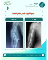 جراحة عظام • تثبيت كسور • جلولاء ديالى