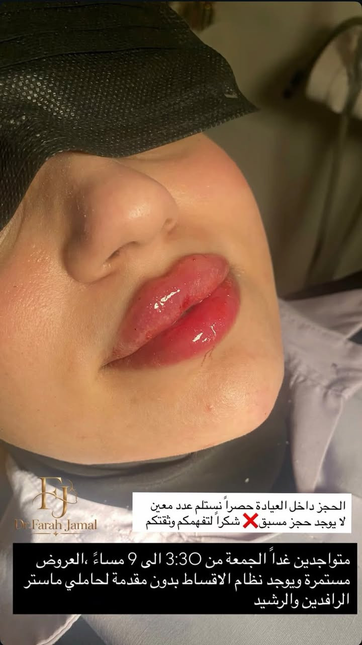 الدكتورة فرح جمال الطائي

نص مكتوب في الصور:
- Dr.Farah Jamal الحجز داخل العيادة حصرا نستلم عدد معين لا يوجد حجز مسبق شكراً لتفهمكم وثقتكم متواجدين غداً الجمعة من 3:30 الى 9 مساءً ،العروض مستمرة ويوجد نظام الاقساط بدون مقدمة لحاملي ماستر الرافدين والرشيد
- تتوفر خدمة التقسيط لحاملي بطاقة ماستر الرشيد على كافة خدمات العيادة في قسمي التجميل والاسنان اقساط بدون مقدمة تصل لمدة سنة كاملة قسم التجميل فلر بوتوكس نضارة و تفتيح الدكتورة فرح جمال الطائي *********** واتساب قسم الاسنان ابتسامة المشاهير حشوات تجميلية حشوات جذور تركيب الاسنان الثابتة والمتحركة تبييض الاسنان زراعة الاسنان قلع وكذالك تتوفر اقساط لحاملي ماستر الرشيد
