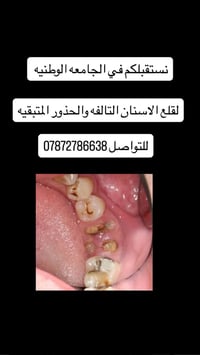 قلع اسنان • جذور متبقيه • الجامعه الوطنيه
