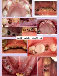 قلع اسنان • مجاني • تخدير موضعي