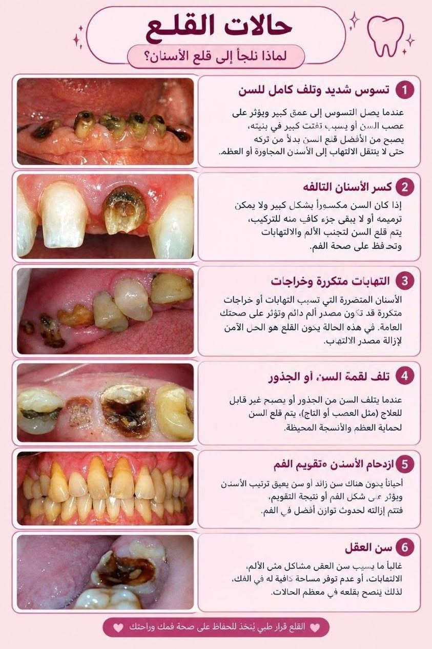 مجاني بالكامل • قلع أسنان • الناصرية