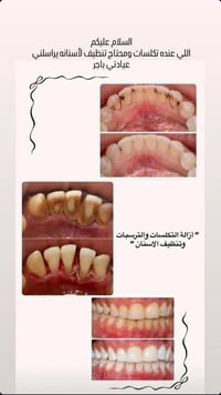 تنظيف الأسنان • إزالة الجير • جامعة بلاد الرافدين