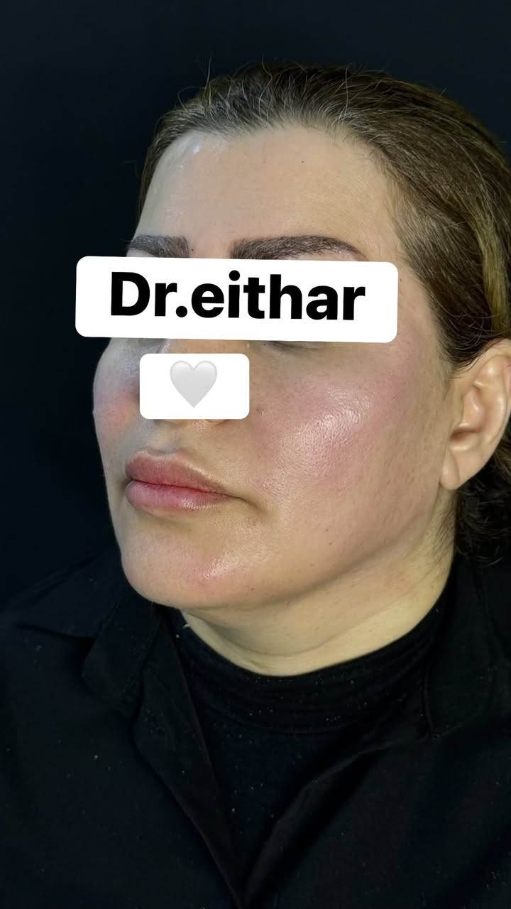 استداره الوجه كامله (لفتنك وجنات واصداغ وتدوير الفك والذقن ونظاره) 🔥🔥

عروووض فرحة الزهره ثبتتهه الكم بالستوري بالهايلايت وببوست اعلى الصفحة ✨✨

د.ايثار سامي عبد الامير
واسط الكوت الهوره مجمع القبطان طابق اول 

الحجز***********
