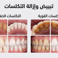 تبييض • إزالة التكلسات • مجاني بس باص