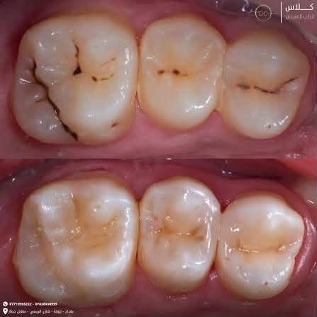 علاج اسنان مجاني • قلع اسنان • كلية الحكمة