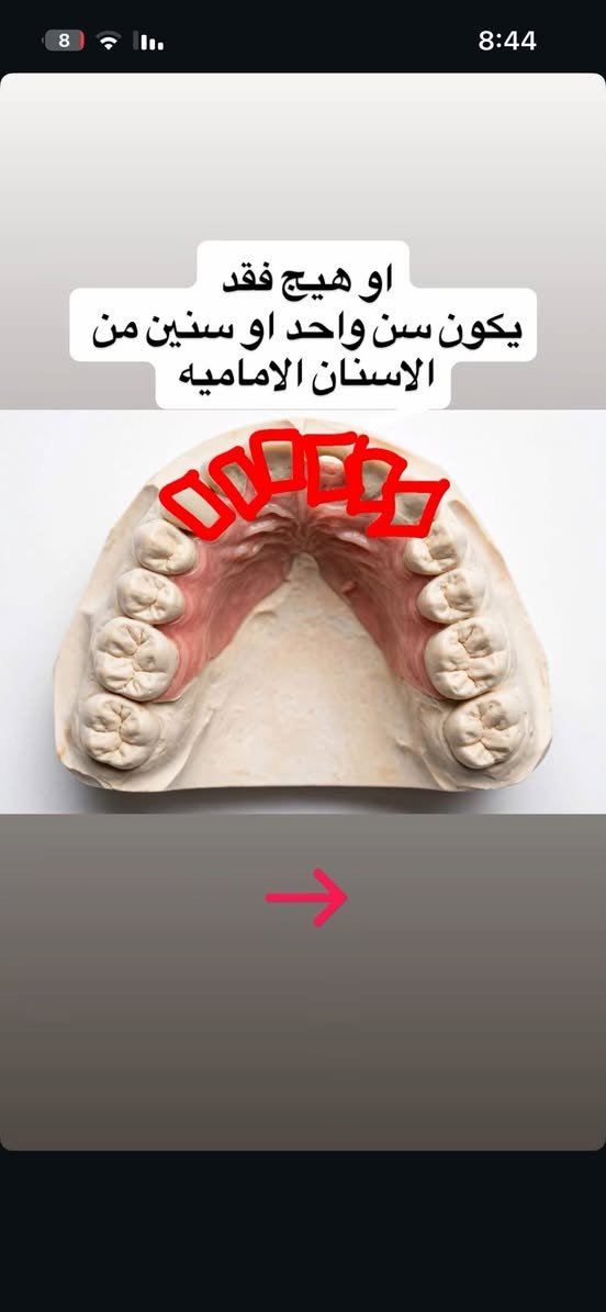 اي حاله عندكم او عند أقاربكم تكدرون تتواصلون خاص للمعالجه + حالات قلع الأسنان والجذور المتبقيه الحجز للأسبقية والعلاج مجاني عدا التعويضات ب اسعار بسيطه

نص مكتوب في الصور:
- احد من اهلكم عنده هيج فقد بأسنانه؟ او شي مشابه لهاي الحاله
- او هيج فقد يكون قبله سن وبعده سن من الجهتين
- او هيج فقد يكون سن واحد او سنين من الاسنان الاماميه
- اذا عندك وحده من هذه الحالات تواصل معي تسوس بسطح السن تسوس بين الاسنان تسوس قريب اللثة كسر بالاسنان
