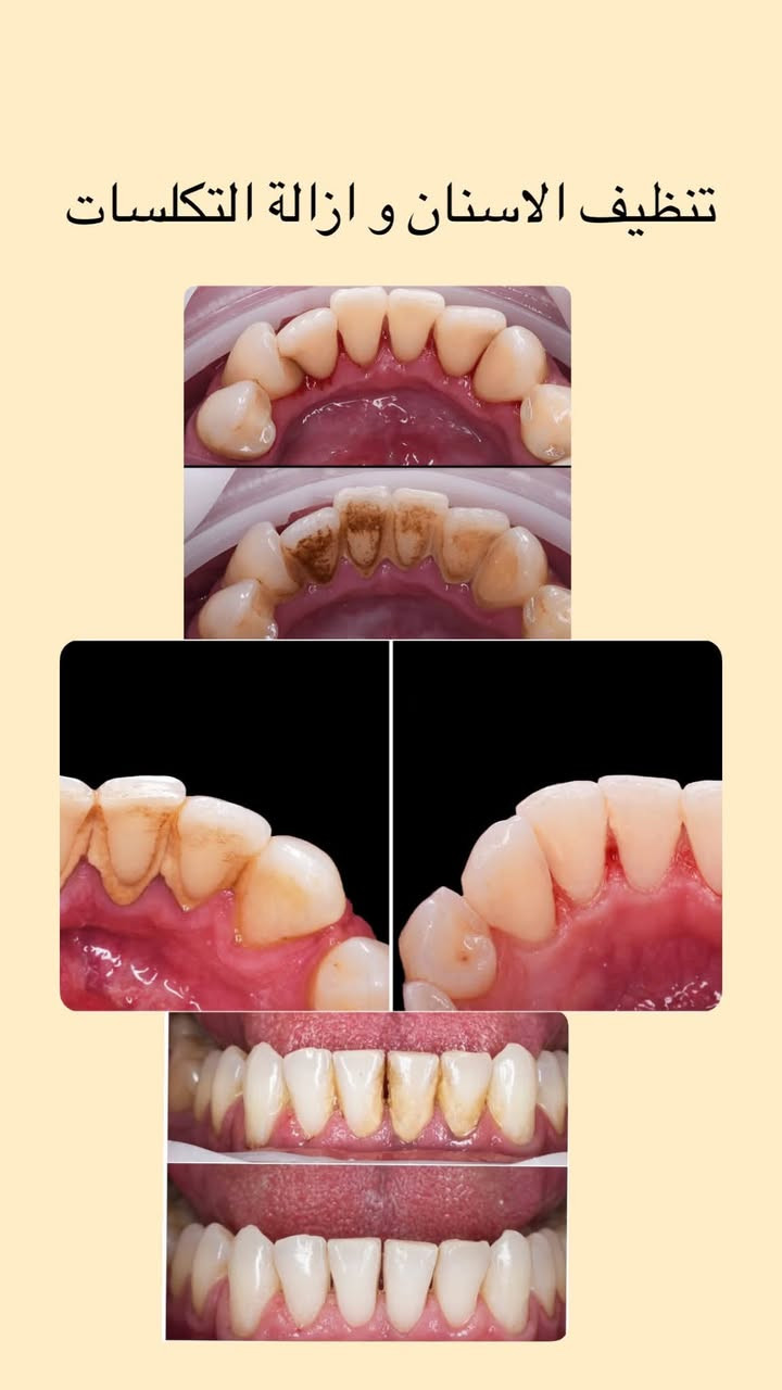 علاج مجاني • طقم جزئي • جامعة النور