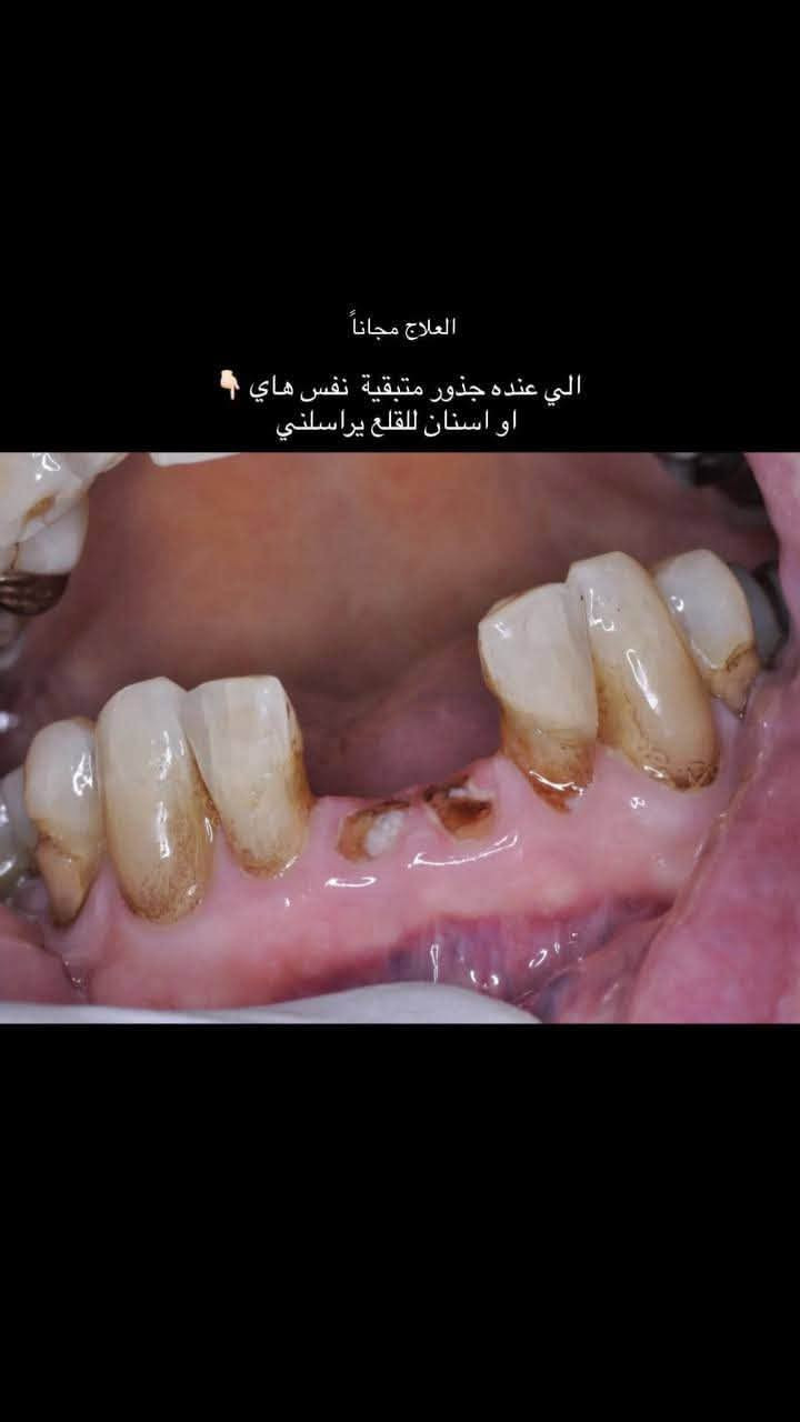 علاج مجاناً • عيادة أسنان • جامعة الزهراوي