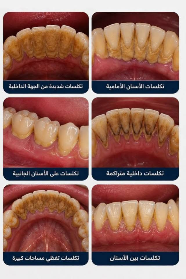 سلام عليكم أي شخص محتاج علاج لأسنانه او يعرف احد محتاج علاج لأسنانه  وحتى الأطفال سواء حشوات ضوئية دائمية أو قلع أو تنظيف لأسنانه او  تعويض طقم كامل يتواصل وياية  على هذا الرقم ***********  

الموقع : عيادات جامعة بلاد الرافدين _تقاطع القدس .
