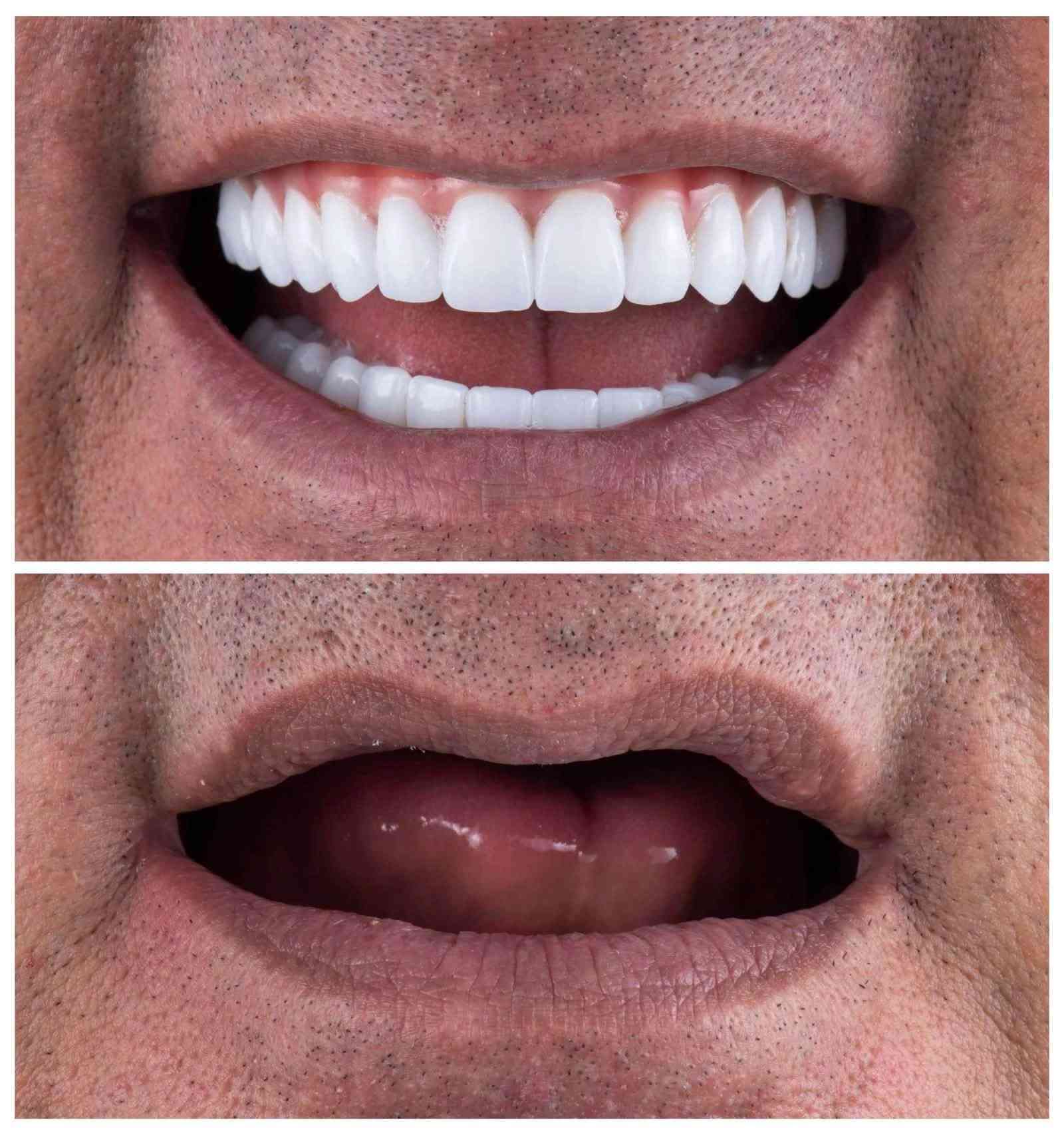علاج مجاني • طقم أسنان • جامعة الرافدين