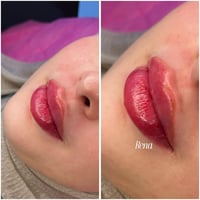 فيلر شفة • رينا • بسماية
