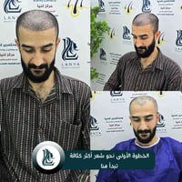 زراعة شعر • مركز لەنیا • كلار شارع ليوا
