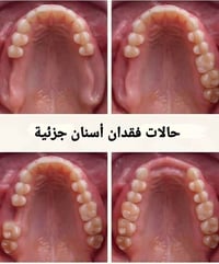 طقم جزئي متحرك • علاج مجاني • فقدان أسنان جزئية