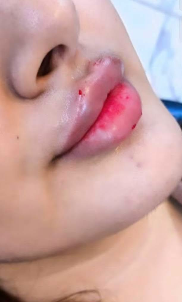 جمال الفلر بيد خبيرة التجميل عروضنا مستمرة مع احلى الرسمات الكرزية 🦋🦋

نص مكتوب في الصور:
- قبل الحقن