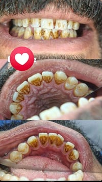 تنضيف اسنان • مدخن • مجاناً
