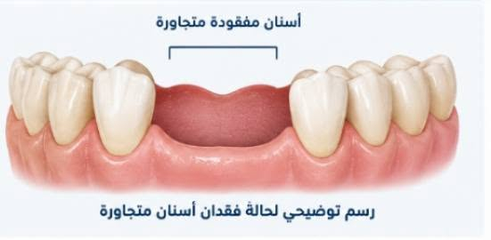 مجاني • تكلسات الأسنان • تعويض الأسنان