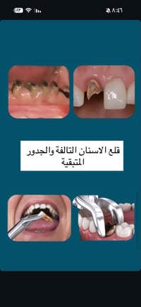قلع الاسنان • علاج الجذور • كربلاء النقيب