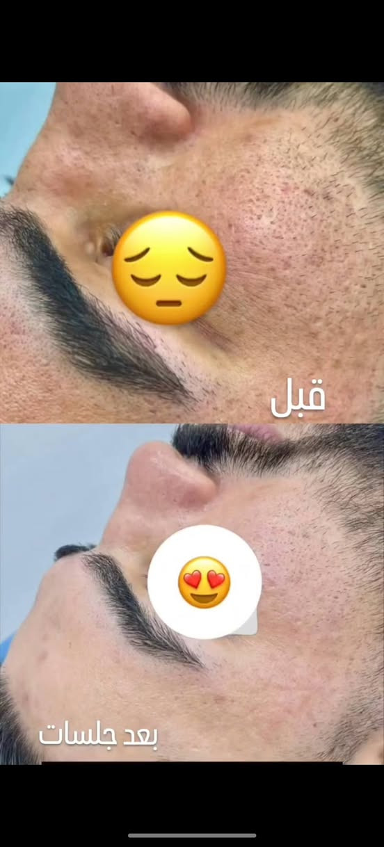 خانقين • فلر الشفايف • بوتوكس