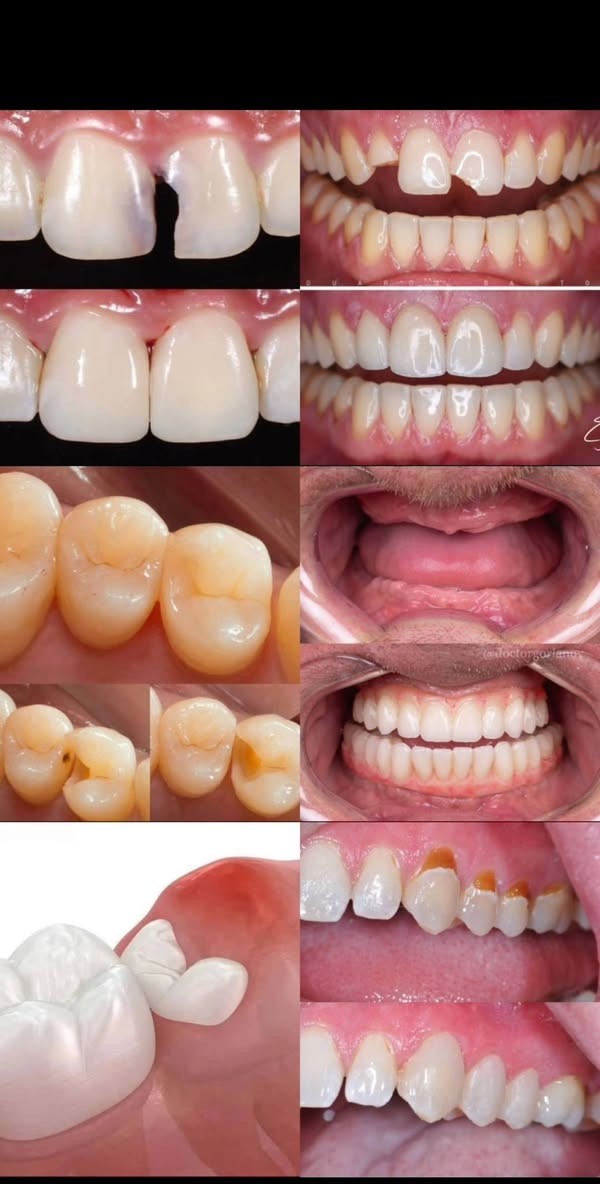 🦷 فرصة لعناية أسنانك مجاناً 🤍
نستقبل حالات مجانية لعلاج الأسنان 🩷
📍 الموقع: عيادات الكفيل ..النجف الأشرف – شارع الإسكان، مقابل مدارس حروف
📲 للحجز والاستفسار: ***********
الخدمات المتوفرة:
🦷 قلع الأسنان والحشوات
✨ تنظيف الأسنان
👧🏻 علاج أسنان الأطفال
🤍 علاج التهابات الفم
الدكتورة حوراء داود سالم 🌷

نص مكتوب في الصور:
- الي يريد يحجز يراسلنا على الخاص *********** مجاني نستقبل القلع والحشوات والتنظيف وعلاج اسنان الاطفال وعلاج التهابات الفم علاج التهابات الفم التنظيف الحشوات القلع وعلاج اسنان الاطفال وعلاج التهابات الفم الدكتورة حوراء داود سالم