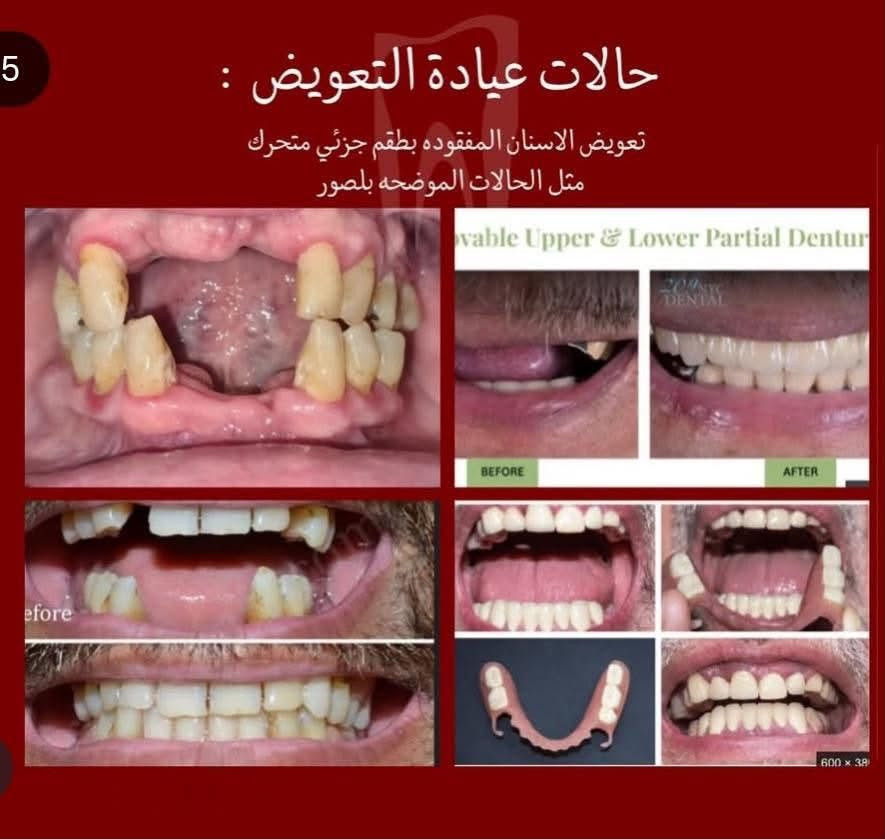 الى كل اهالي الدورة الاحباء حبينا نذكركم ما تهملون اسنانكم ! اهالينا كبار وصغار😍
صراحة الدكتورة ما اعرفها لكن على شغلها والدقة كلت ضروري اي شخص بالدورة او قريب من الدورة يعاني من اي مشكلة من المشاكل الموجودة تحت في الصور 
شغل نظيف ايد خفيفة والاهتمام بكل التفاصيل 
طبعا لليسألون الدكتورة تشتغل داخل عيادات جامعة دجلة لطب الاسنان مجانااا مجانااا 
اذا حابين تعرفون تفاصيل اكثر وايام الشغل تواصلوا مع الرقم واتساب رصيد موجود
***********

نص مكتوب في الصور:
- حالات عيادة التنظيف : التكلساات التصبغات بسبب التدخين والمشروبات اي احد يحب يسوي تنظيف يكدر يتواصل ويايه ( اللي موضح بلصوره كذلك )
- حالات عيادة الجراحة : بقايا جذور الاسنان التالفه الاسنان المتحركه الاسنان التالفه
- 5
- حالات عيادة التعويض :
- تعويض الاسنان المفقوده بطقم جزئي متحرك مثل الحالات الموضحه بلصور
- ovable Upper & Lower Partial Dentur
- BEFORE
- AFTER
- efore
- 600 x 38
- حالات عيادة الحشوات : حافات الاسنان المكسوره تسوس قريب اللثه ازالة الحشوات القديمة تسوس على سطح السن بين الاسنان الخلفيه بين الاسنان الامامية