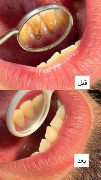 جامعة المعارف • تنظيف أسنان • معالجة جذور