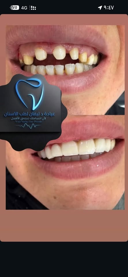 التعقيم: نطبق أعلى معايير منظمة الصحة العالمية لضمان سلامتك.
التقنيات: نستخدم الأشعة الرقمية (Digital X-Ray) لتقليل الانبعاثات وزيادة دقة التشخيص.

​الراحة: كادر طبي متعاون وبيئة هادئة بعيدة عن التوتر.

​المتابعة: لا تنتهي علاقتنا بك بانتهاء الجلسة، بل نتابع معك لضمان استدامة النتائج.

​📞 للحجز والاستفسار:

​📍 العنوان: [ - كركوك الحويجة حي الثورة شارع البورصة..]

​📱 رقم الهاتف: [***********]

​🕙 أوقات الدوام: متواجدين 24ساعة على مدار أليوم شوكت متجي حياك الله 

​دليڤان لطب الأسنان.. لأنك تستحق أن تبتسم بثقة!🦷
