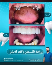 زراعة أسنان • عيادة القريشي • ال بدير