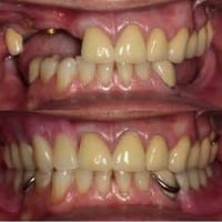 بعيادات جامعة كلكامش 🦷 ⭕️ نشتغل طقم جزئي متحرك ❗️العلاج تحت إشراف اطبا...