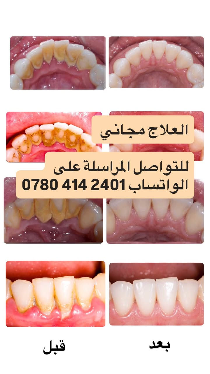 متوفر لدينا مراجعة و علاج مجاني 
تحت إشراف كادر طبي متخصص
داخل عيادات جامعة الفراهيدي 
كلية طب الاسنان 📍
الحالات / تنظيف ، علاج تسوس الأسنان (حشوات) ، القلع
مواعيد محددة احجز الان

نص مكتوب في الصور:
- العلاج مجاني
- للتواصل المراسلة على
- الواتساب ***********
- بعد
- قبل
- العلاج مجاني للتواصل المراسلة على الواتساب *********** قبل بعد