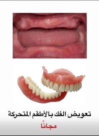 تعويض الفك • أطقم متحركة • مجاناً