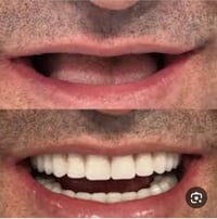 تعويض اسنان • عيادات جامعه الهادي • الدوره بغداد