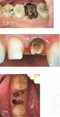 مجاناااااً  سارعوا بالحجز  الي عنده اسنان تحتاج قلع او بقايا جذور تالف...