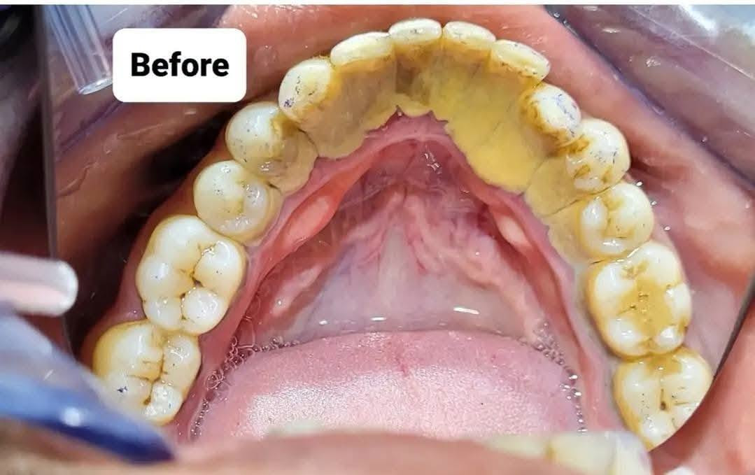 على بركة الله نعاود استقبال الحالات التالية في عيادات جامعة الحلة 🦷
-الحشوات الضوئية (الحشوة البيضاء)
_تنظيف الاسنان وازالة التكلسات 
_قلع الاسنان التالفة والجذور المتبقية
_تعويض الاسنان المفقودة بطقم كامل
_قلع وحشوات ومعالجة اسنان الاطفال

🔴العلاج بشكل شبه مجاني 

الموقع🔻 :شارع اربعين،مجاور صيدلية سلامتك

للحجز والاستفسار📞: ***********

نص مكتوب في الصور:
- Before