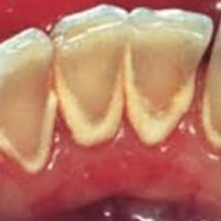 تنظيف أسنان • مجاناً • طلاب أسنان