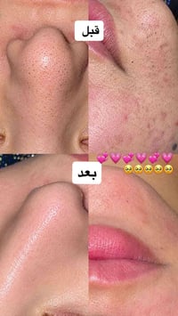 هايدرافيشل • ترطيب مكثف • القيارة