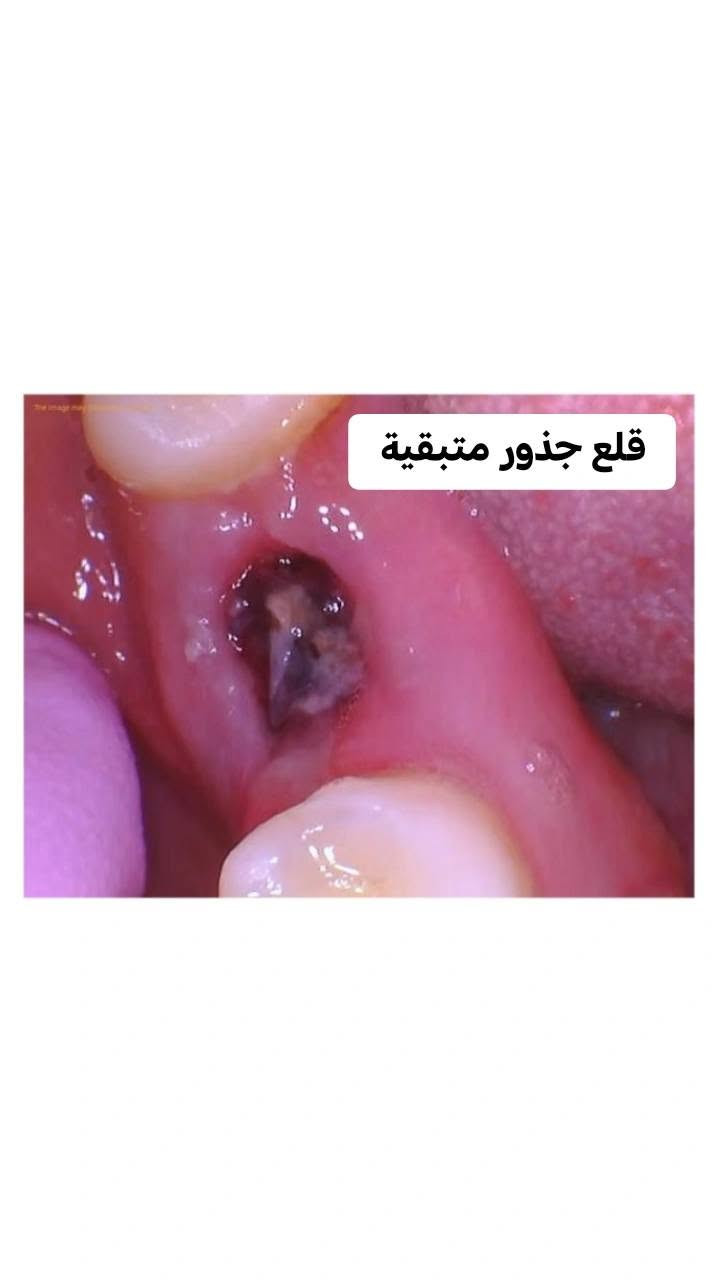 السلام عليكم العلاج مجاني للي عنده هيج حالة 
للتواصل واتساب ***********
او التواصل خاص 
العلاج تحت اشراف اطباء متخصصين 
العنوان:جامعة اشور شارع مطار المثنى

نص مكتوب في الصور:
- براء خالد غيلان طبيبة أسنان حشوات تجميلية قلع أسنان تنظيف أسنان وإزالة تكلسات تعويض أسنان مفقودة العلاج مجاني تحت إشراف مختصين *********** b0ara جامعة اشور شارع مطار المثنى
- تنظيف الاسنان وازالة التكلسات
- قلع جذور متبقية
- حشوات تجميلية للاسنان المكسورة
- Dr. Salah
- Abdullahteeth
- ALKHAZAN