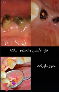 قلع أسنان • حشوات • مجاني