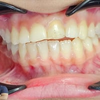 مراجعة • عضة مفتوحة • تقويم معدني